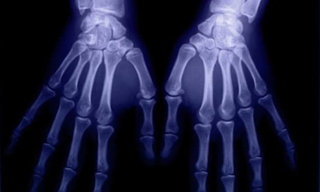Common Sites of Bone Erosion in Rheumatoid Arthritis ID’d on US