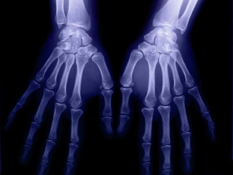 Common Sites of Bone Erosion in Rheumatoid Arthritis ID’d on US