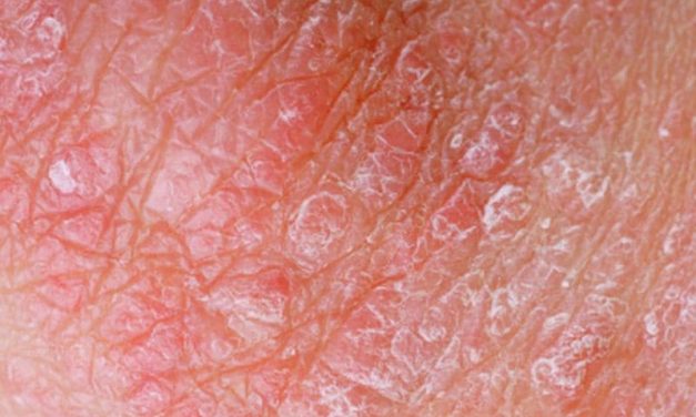 Psoriasis Biomarkers as Predictors of UVB Phototherapy Effectiveness