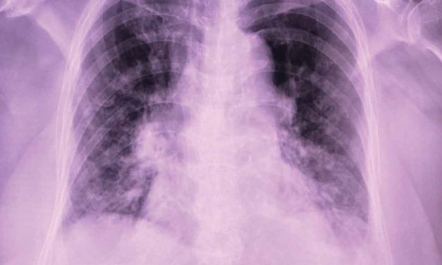 RA Activity & Incident RA–Associated Interstitial Lung Disease