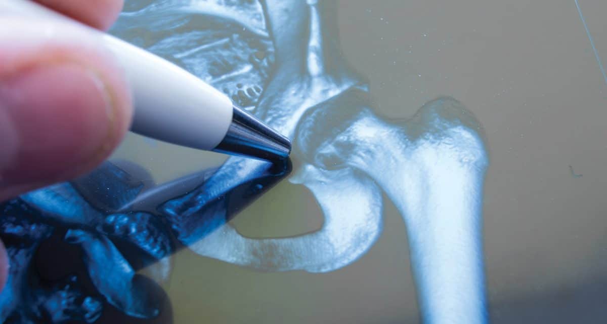 Odanacatib for Postmenopausal Osteoporosis