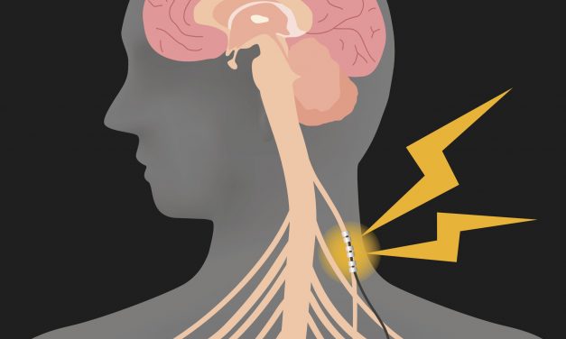 Examining the Link Between Migraine With Aura and Stroke