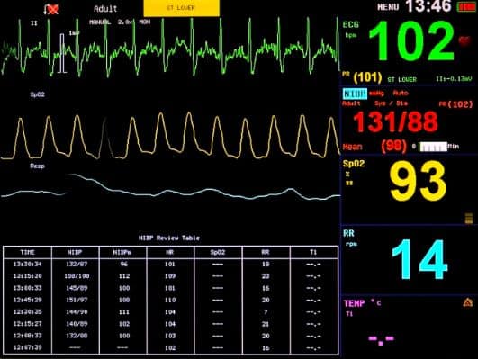 Update: Mortality rate of COVID-19 patients on ventilators