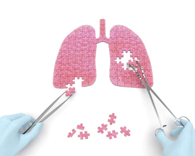 New Immunotherapy Treatment Promising for NSCLC