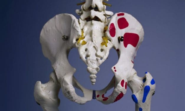 Low Physical Function May Up Bone Loss After Hip Fracture