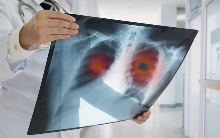 Adherence to Imaging Guidelines ‘Very Poor’ After Early NSCLC Treatment
