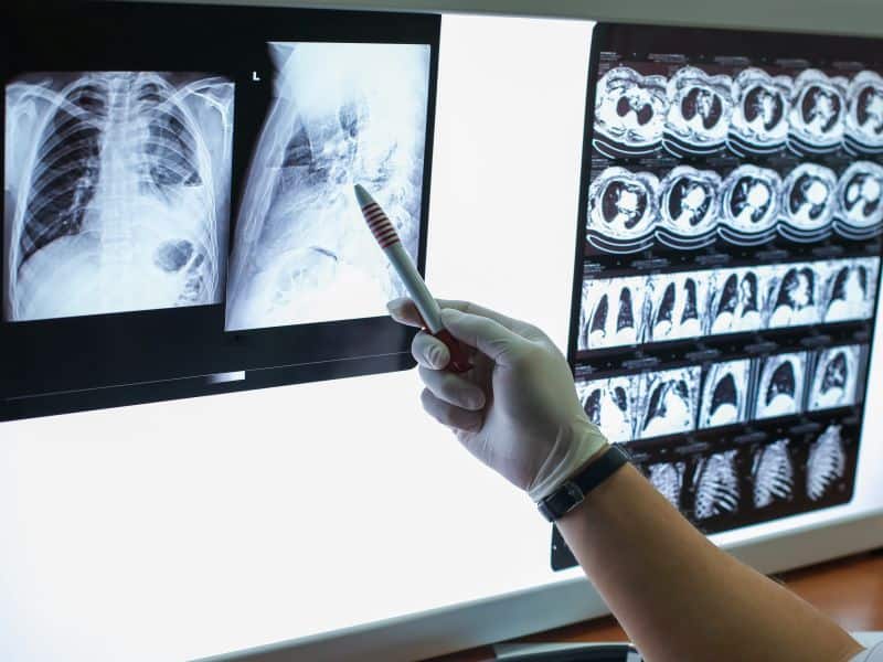 Lung Cancer Treatment Plans Changed Due to Pandemic
