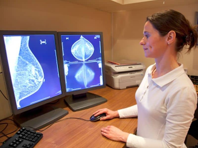 Abemaciclib Beneficial for HR+, HER2− Early Breast Cancer