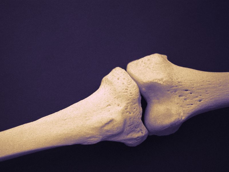 Risk for Bone Fractures Up for Patients With Psoriatic Diseases