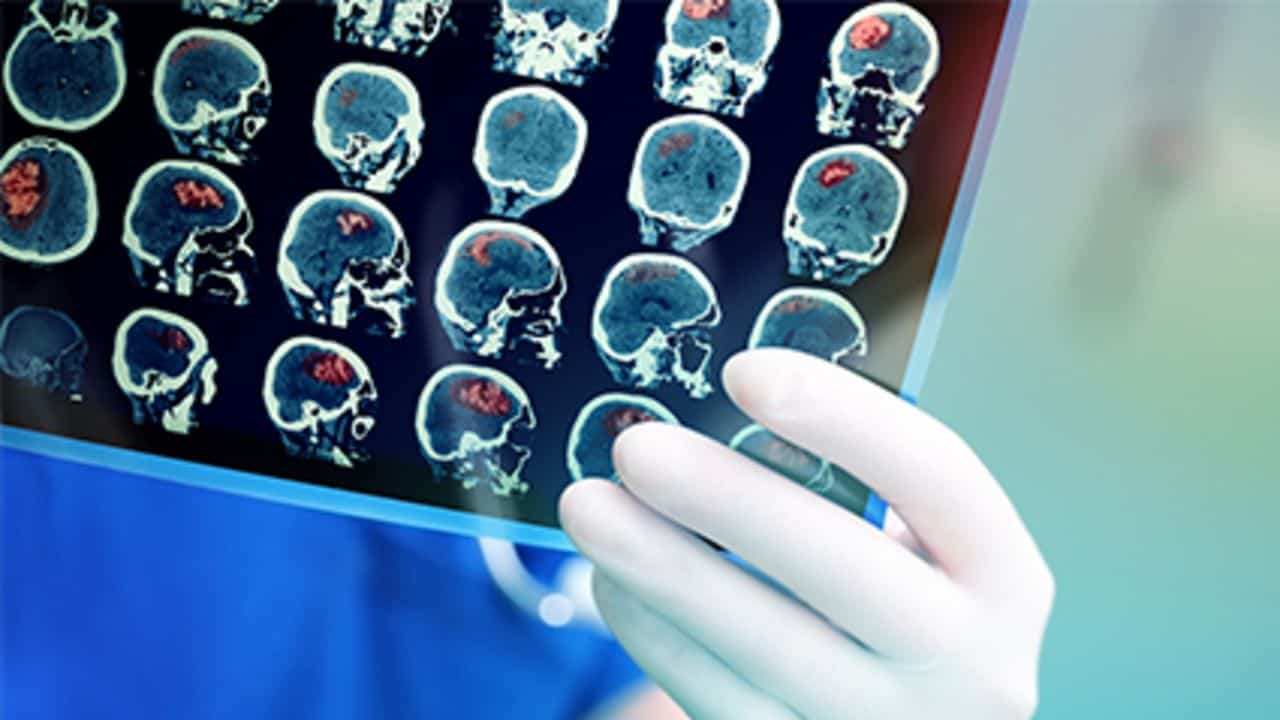 Out-of-Pocket Costs Rising for Neurology Tests, Visits