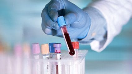 First Blood Test for Alzheimer Disease Available in U.S.