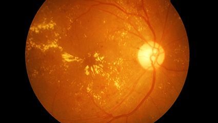 Air Pollution May Up Risk for Age-Related Macular Degeneration