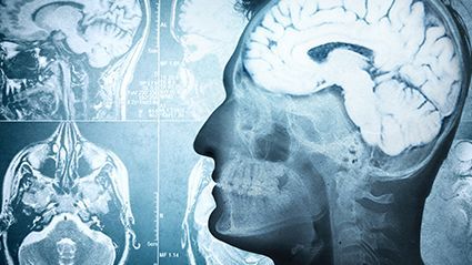 Link Between T. gondii Infection, Glioma Risk Examined