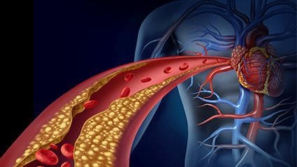 USPSTF Advises Against Screening for Asymptomatic Carotid Artery Stenosis