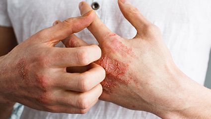 Severe, Active Atopic Eczema Tied to Increased Mortality Risk