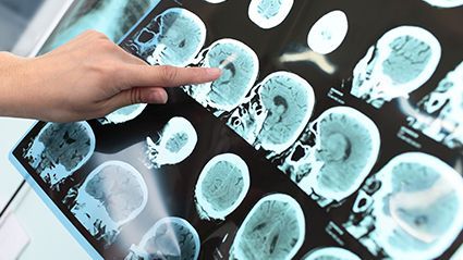 Head Injury Linked to Long-Term Risk for Dementia