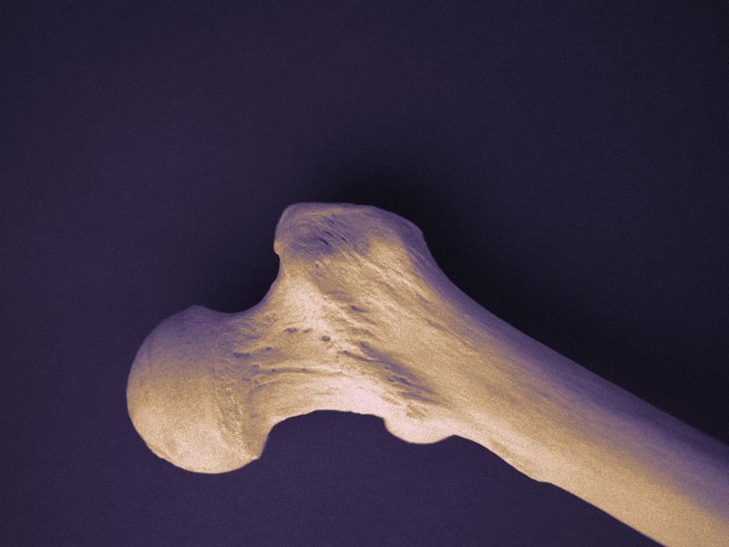 Bone Density Testing Low in Veterans With Kidney Stone Disease