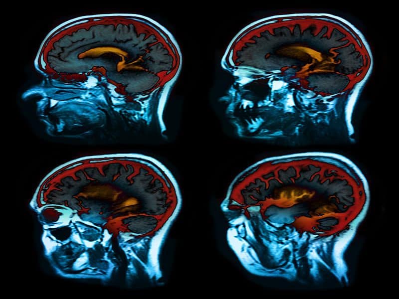 CV Risk Factors, Atherosclerosis May Alter Brain Metabolism