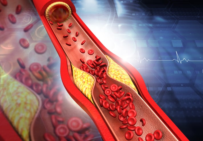 Hypercholesterolemia in Young Adults Often Untreated/Undertreated