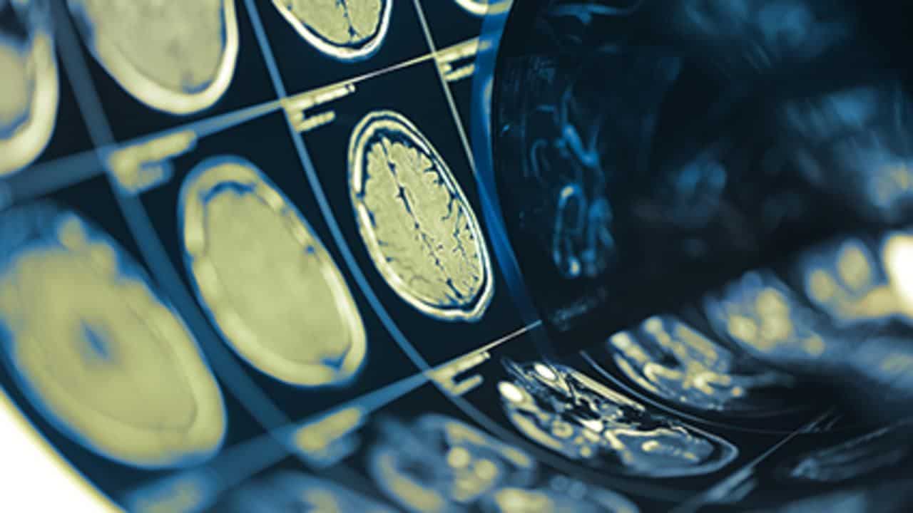AI Algorithm Uses Brain MRI to ID Multiple Sclerosis Subtypes