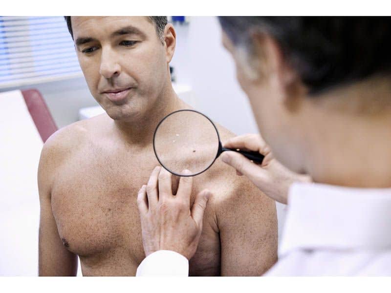 Screening May Improve Early Detection for Melanoma-Prone