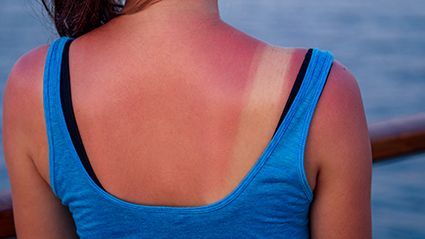 Sunburns Severe Enough to Warrant Admission Described