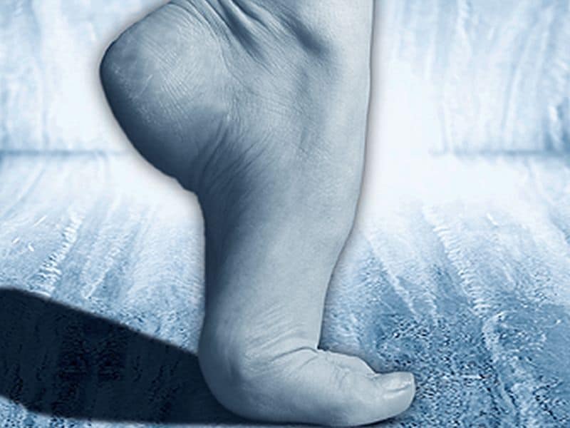 Undiagnosed A-Fib Detected During Diabetic Foot Exam