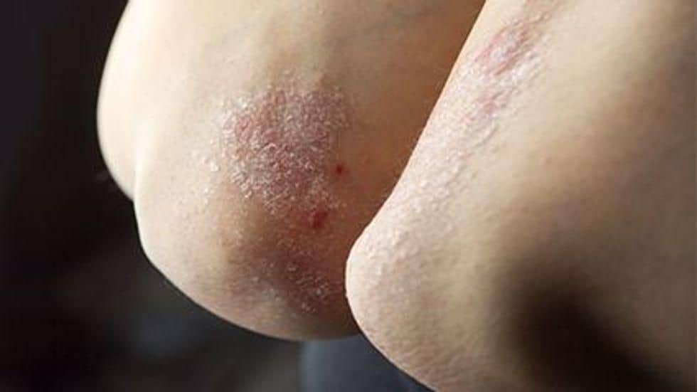 More Body Surface Area Clearance With Psoriasis Tied to Better Quality of Life