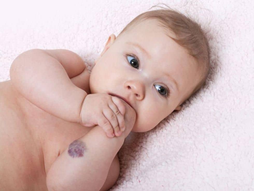 Risk Factors for PHACE Syndrome ID’d in Infantile Hemangiomas