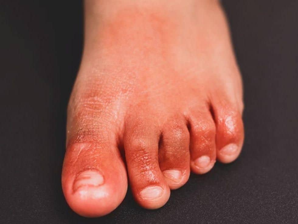 COVID-19 Weakly Correlated With Chilblains Incidence