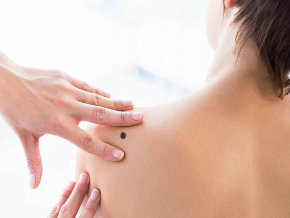 Barriers to Physician Skin Exam ID’d for Young Melanoma Survivors