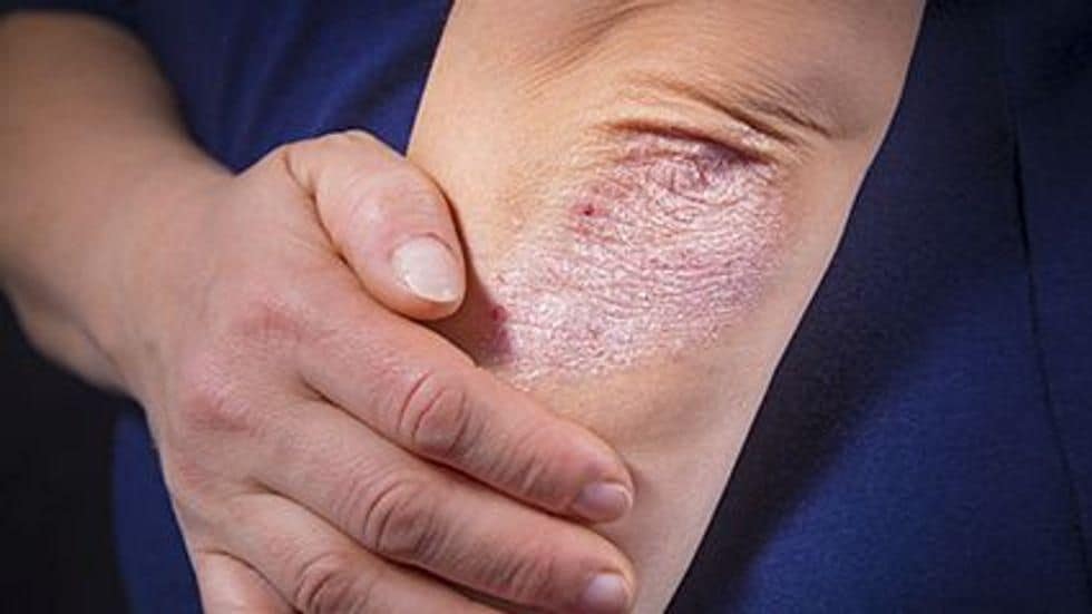 Risk for Psoriasis Increased for Cancer Survivors