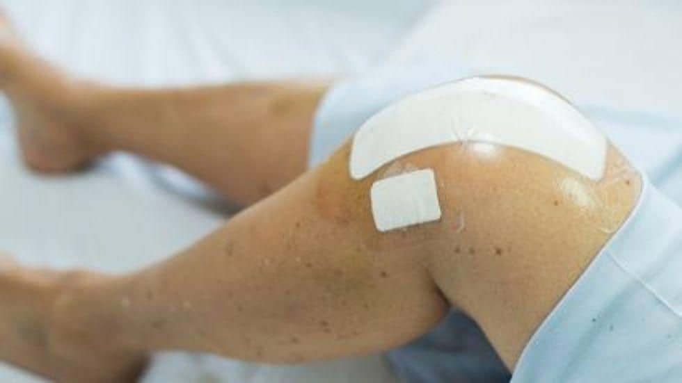 Abelacimab Prevents VTE After Total Knee Arthroplasty