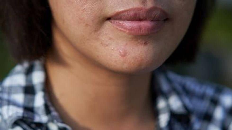 Acne Negatively Impacts Emotional Health of Adult Women