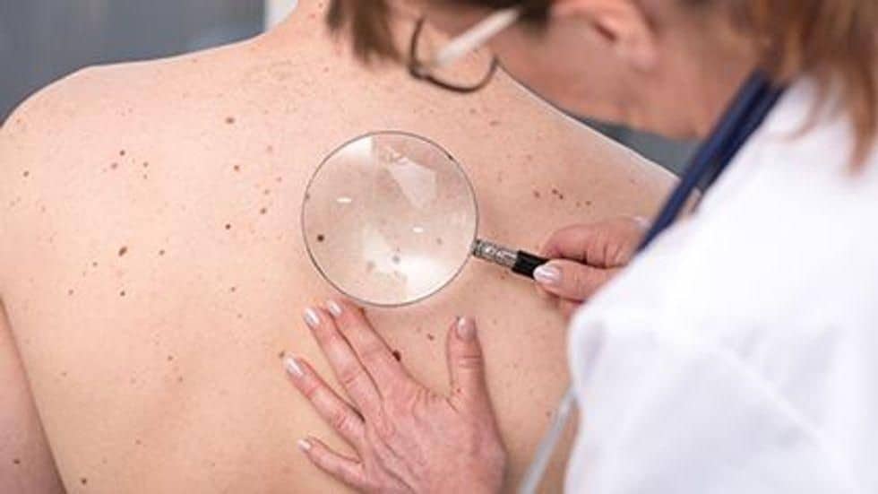 Fewer Cancers Might Be Missed With Full-Body Skin Examinations