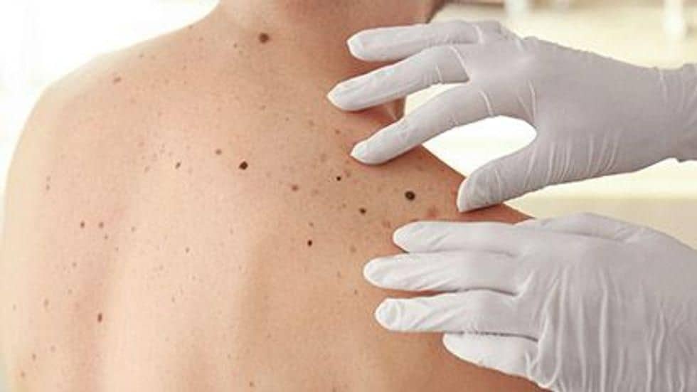 Certain Dermoscopic Structures Linked to Melanoma Detection
