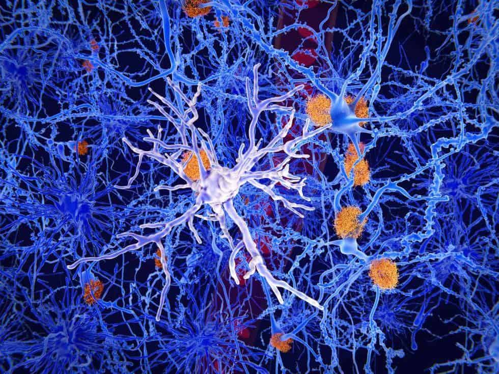 Plasma Amyloid-Beta at Midlife Linked to Later MCI, Dementia