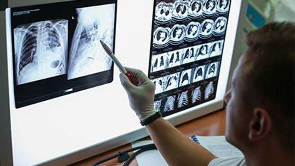 Guidance Issued for Low-Dose Chest CT Screening for Lung Cancer