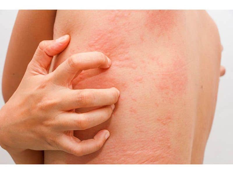 Eczema, Psoriasis, Hidradenitis Suppurativa Linked to CKD