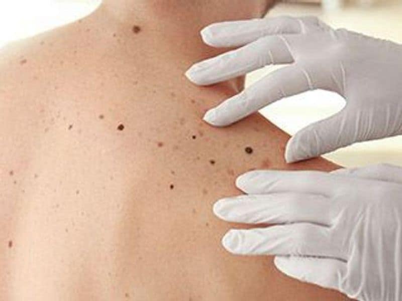 All-Cause Mortality Lower for Melanomas ID’d in Routine Skin Checks