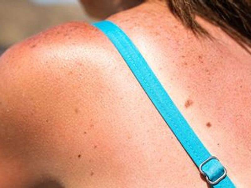 Most Teens, Young Adults Knowledgeable About Sun Protection