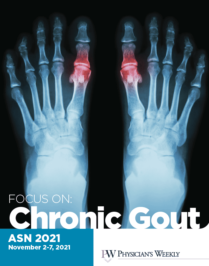 ASN 2021: A Focus on Chronic Gout eBook