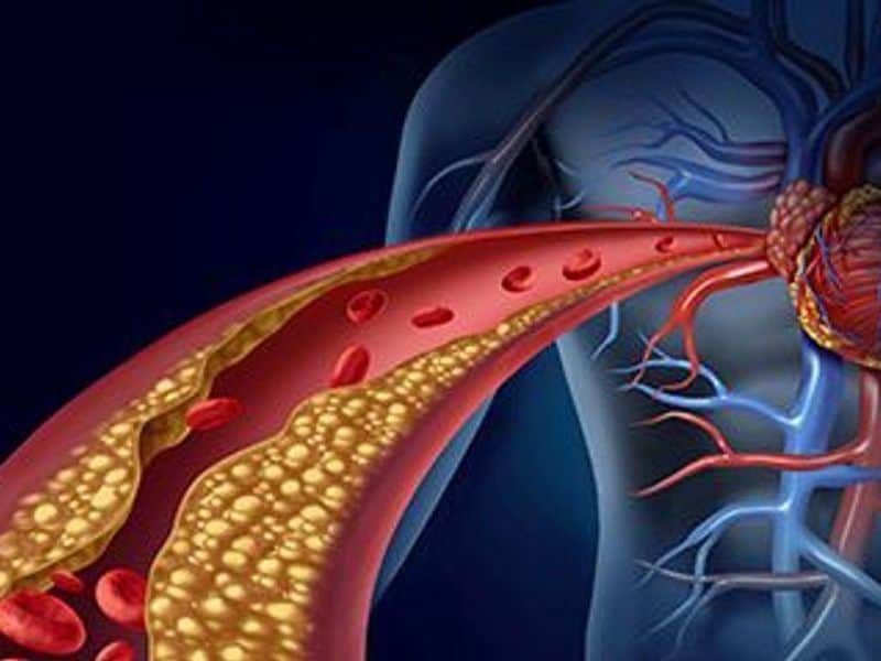 Exposure to Nonessential Metals Linked to Risk for Atherosclerosis