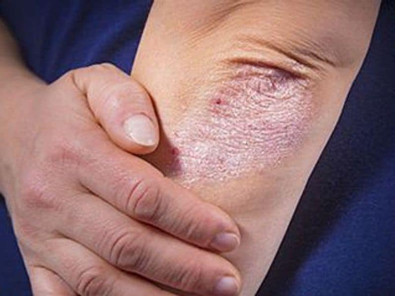 AI Allows Automated Scoring of Psoriasis Area, Severity