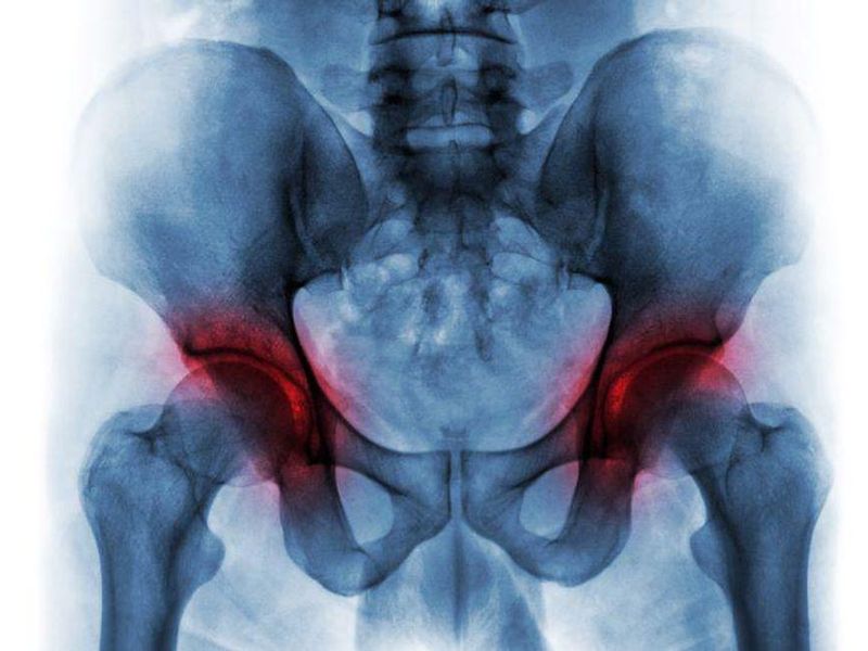 AAOS Updates Guideline for Managing Hip Fracture in Seniors