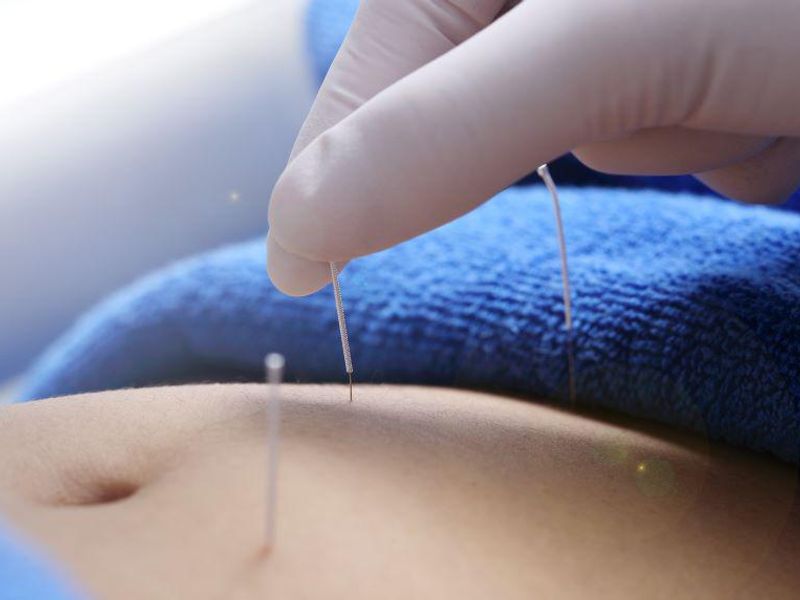 Insurance Coverage for Acupuncture Up From 2010 to 2019