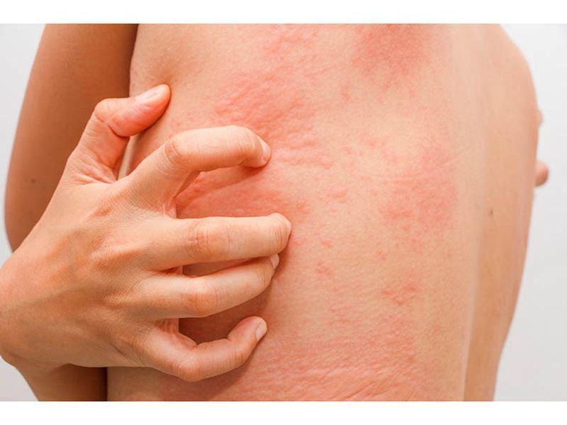 FDA Approves Rinvoq for Treatment of Atopic Dermatitis