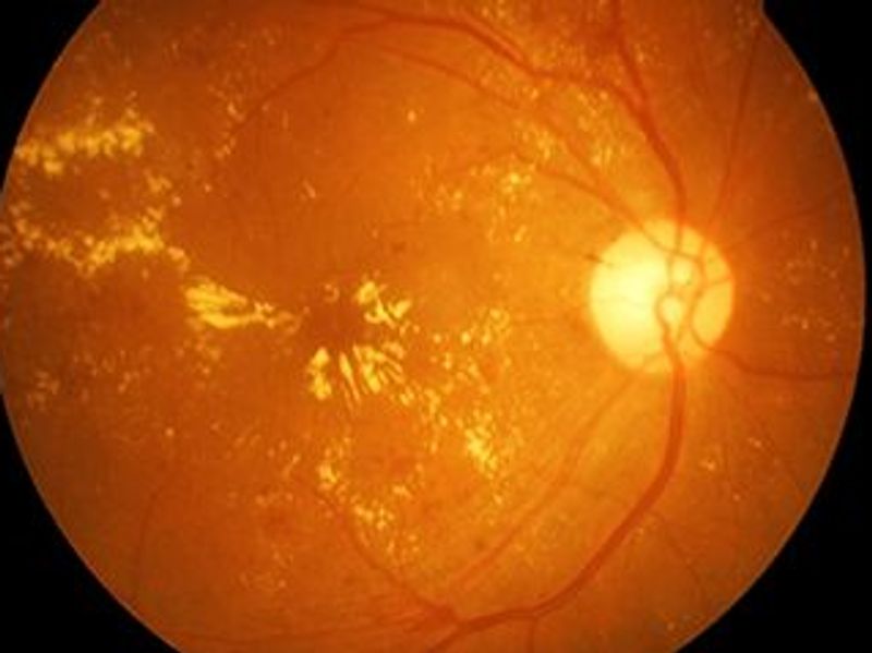 Gap Between Retinal Age, Chronological Age Tied to Mortality