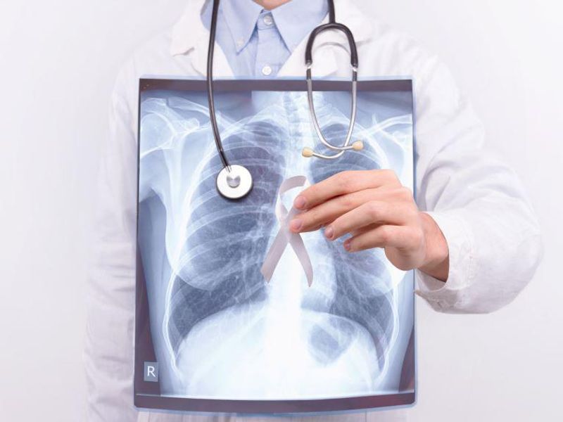 Blood Biomarkers May Help Assess Need for Lung Cancer Screening