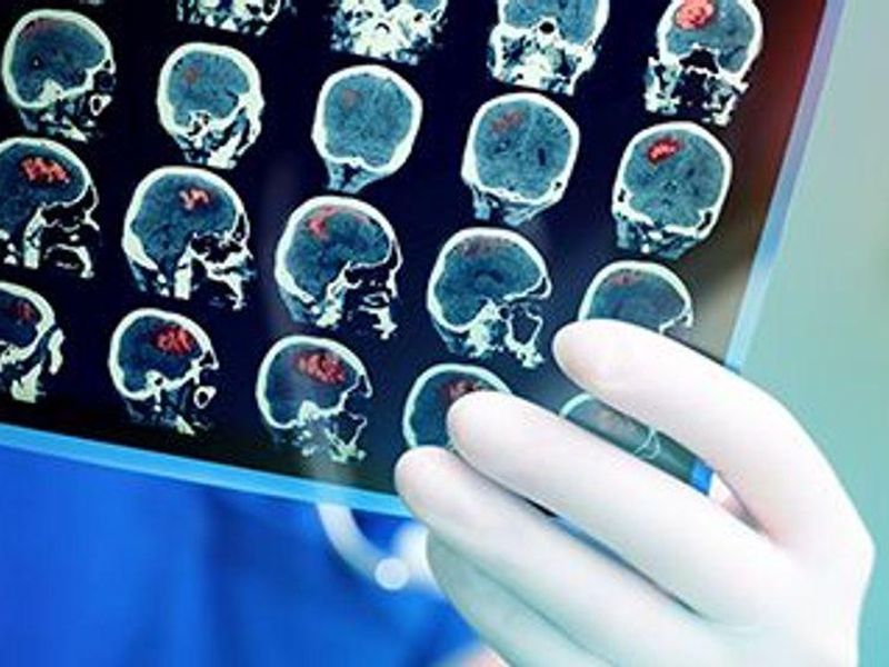 Updated Brain Injury Guidelines Validated for Complicated mTBI